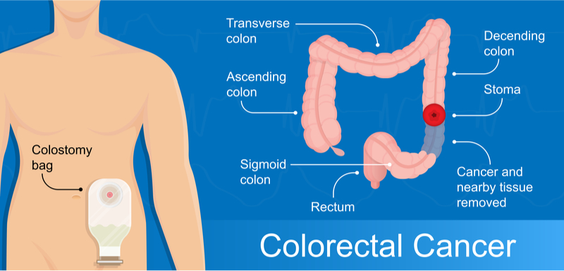 Large bowel resection Information | Mount Sinai - New York